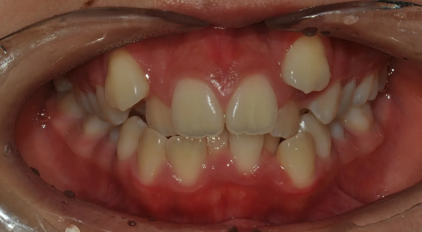 Before