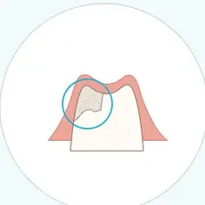 부족한 부위에 잇몸뼈를 이식하는 그림