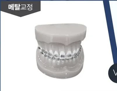 메탈 브라켓을 부착한 치아 모형