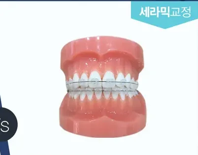 세라믹 브라켓을 부착한 치아 모형