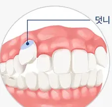 송곳니가 치아 사이로 삐뚤게 나온 덧니를 표시한 그림