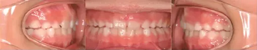 Case I,II 부정교합 8세 여아 (교정 4개월 후 치열 개선 효과) 구강 사진 3컷