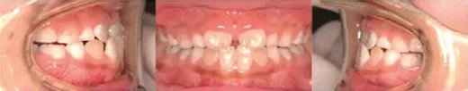 Case III 부정교합 8세 남아 (교정 전) 구강 사진 3컷