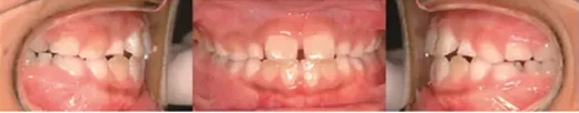 Case III 부정교합 8세 남아 (교정 3개월 후 반대교합 효과) 구강 사진 3컷