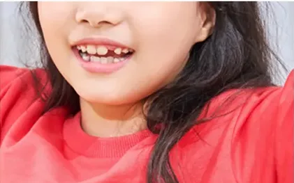 유치가 빠진 자리가 보이도록 웃는 어린이